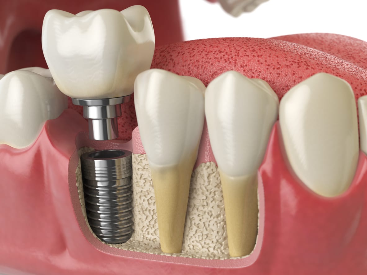 Dental Implants Procedure Simi Valley CA