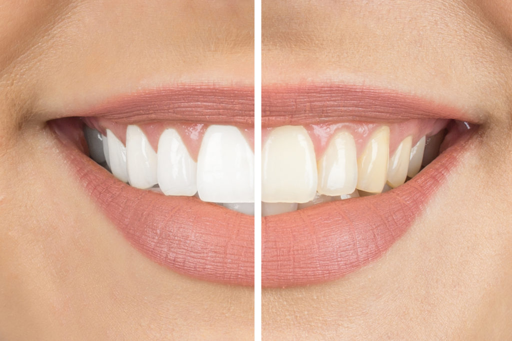 before & after teeth whitening Simi Valley CA