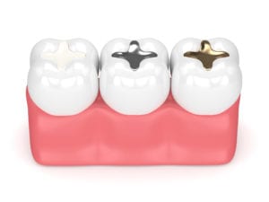 Tooth-Colored Fillings Moorpark CA