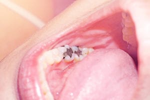 Tooth-Colored Fillings Process Moorpark CA