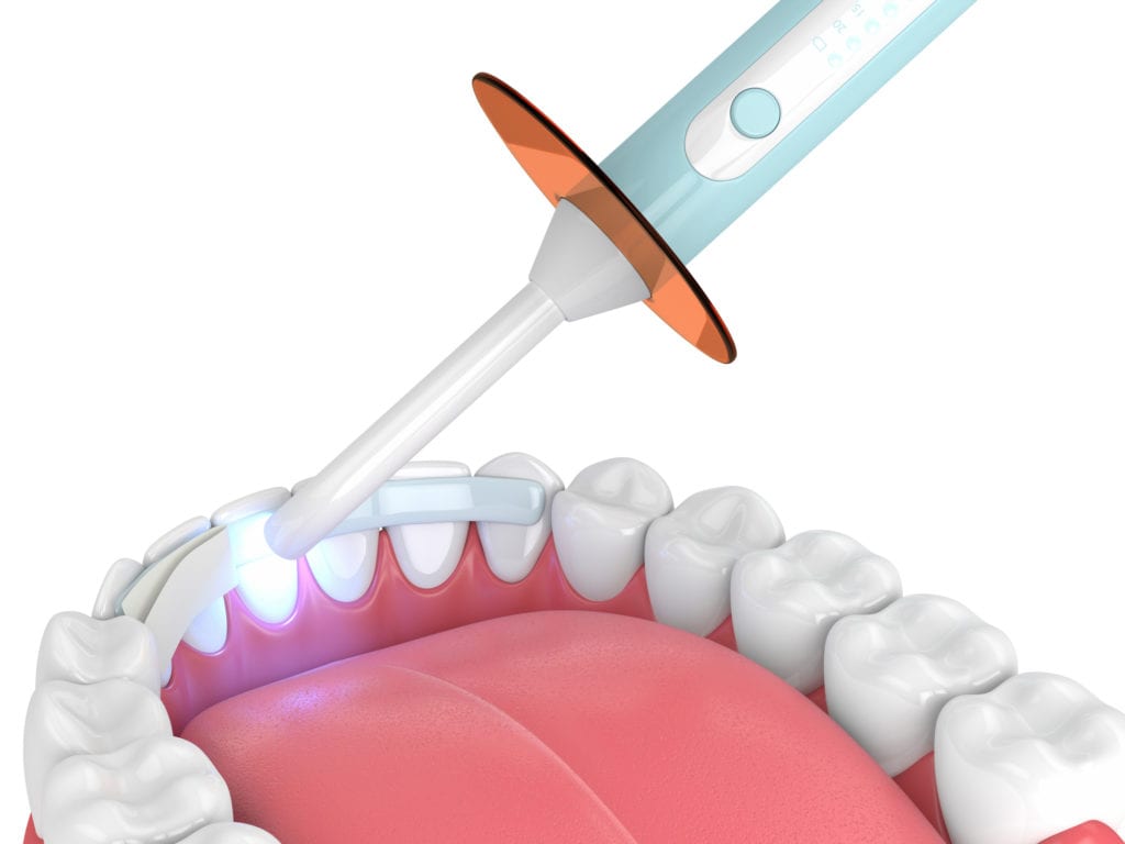 3d render of jaw with dental bonding lamp and dental fiber over white background
