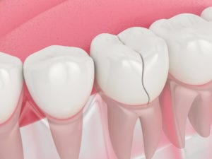 Dental Bonding Moorpark CA