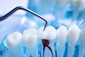 Root Canal Moorpark CA