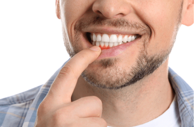 What Causes Pale Gum Tissue Robert D Bankhardt Dds Inc
