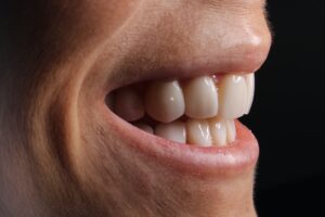 porcelain-veneers