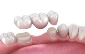 Illustration of a dental bridge (held by two crowns) for filling in a gap in a smile due to a missing tooth
