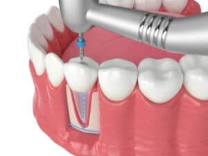 Illustrated depiction of root canal to strengthen a tooth that's been weakened by decay.