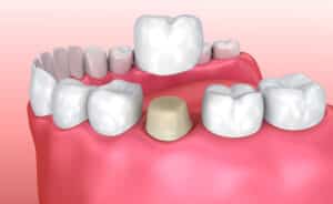Illustrated rendering of a crown being put on a tooth as a restorative dentistry option