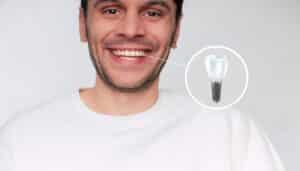 Caucasian man smiles. He has a dental implant that fits in seamlessly with his natural teeth