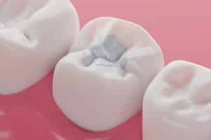 White composite tooth filling repairs an infected tooth
